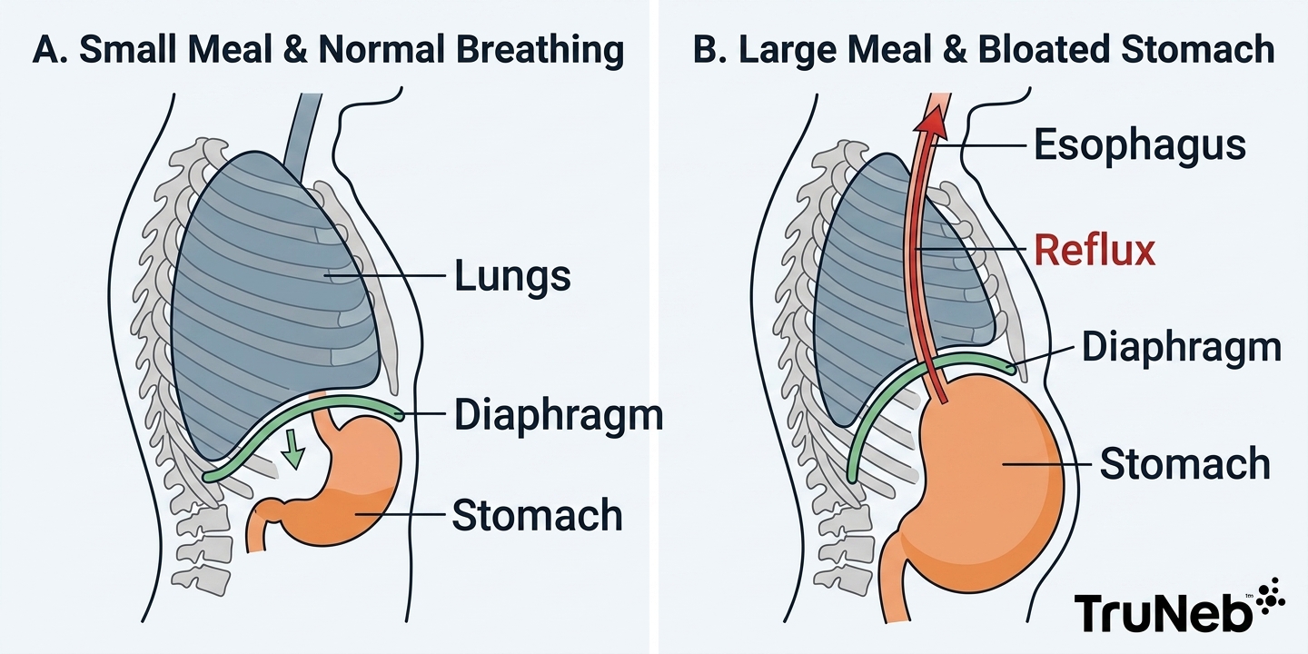 Diagram showing how a full stomach and reflux can push up on the diaphragm and limit lung expansion.