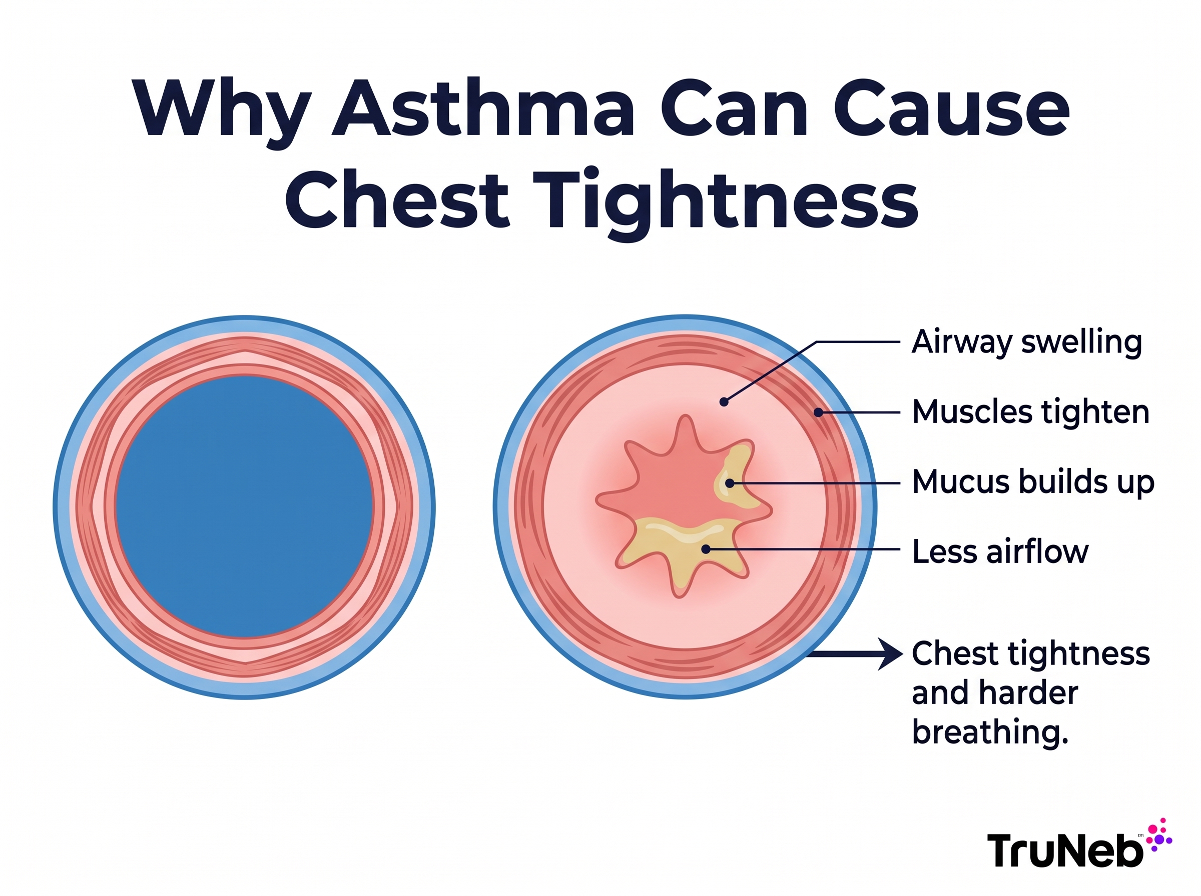 Diagram showing asthma-related airway swelling, muscle tightening, and mucus narrowing the airway and contributing to chest tightness.